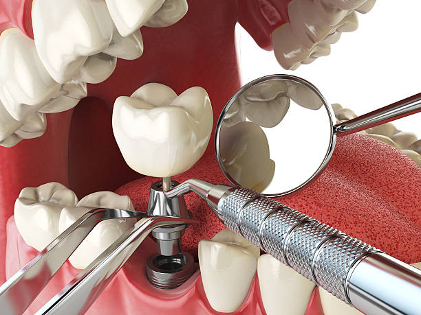 Best Lost Filling or Crown Replacement in Sierra Madre, CA